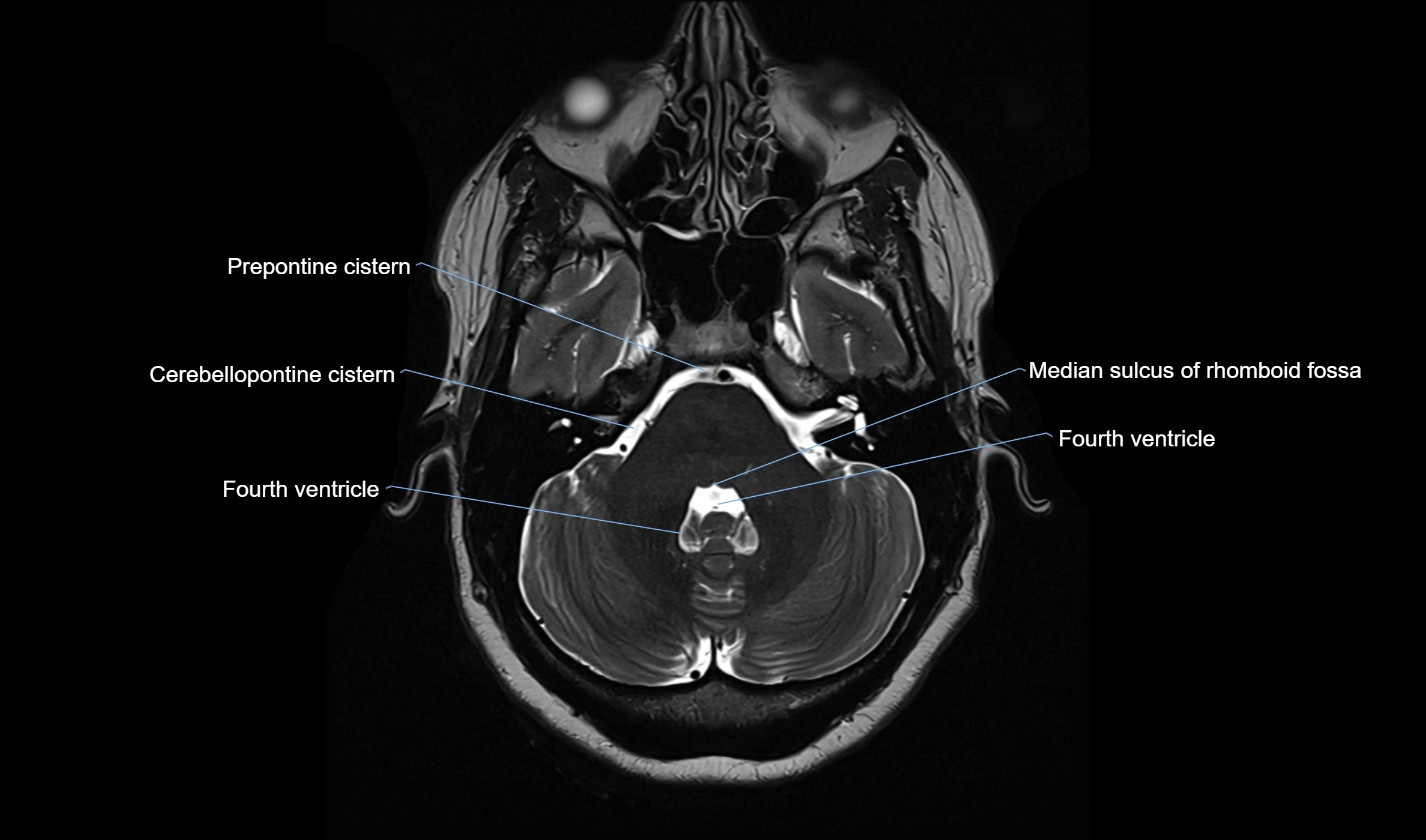 Brain cisterns  and ventricles  axial anatomy 3T MRI image-img-00001-00013.webp